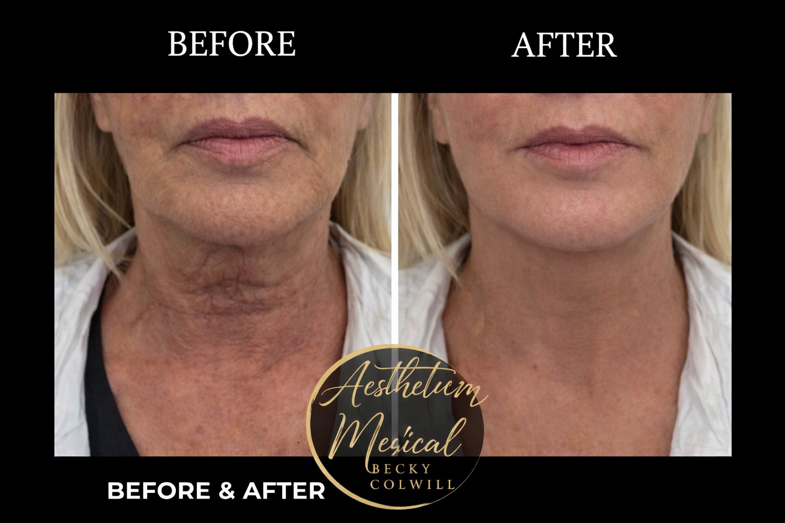 Before and after — Neck & Décolletage